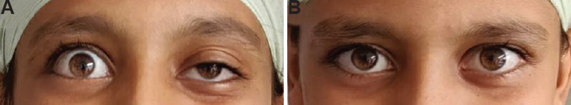 (A) Ptosis of left eye at the time of presentation. (B) Improvement in ptosis of left eye after treatment with Pyridostigmine.